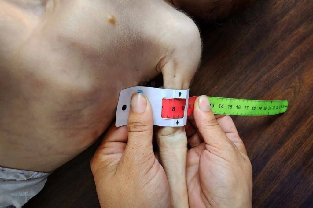 سنتيمترات معدودة.. أذرع أطفال غزة تختصر حجم مأساة الجوع