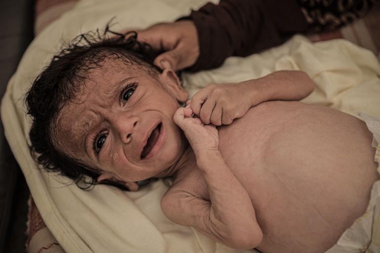 GAZA CITY, GAZA - JULY 26: Seven-month-old Salim Mahmoud Awad suffers significant weight loss due to the lack of baby formula and food after being displaced to Gaza City, Gaza with his family, on July 26, 2025. Struggling with malnutrition, the infant's health continues to deteriorate as Israel's strict blockade on the Gaza Strip pose a serious threat to the lives of infants. ( Ahmed Jihad Ibrahim Al-arini - Anadolu Agency )
