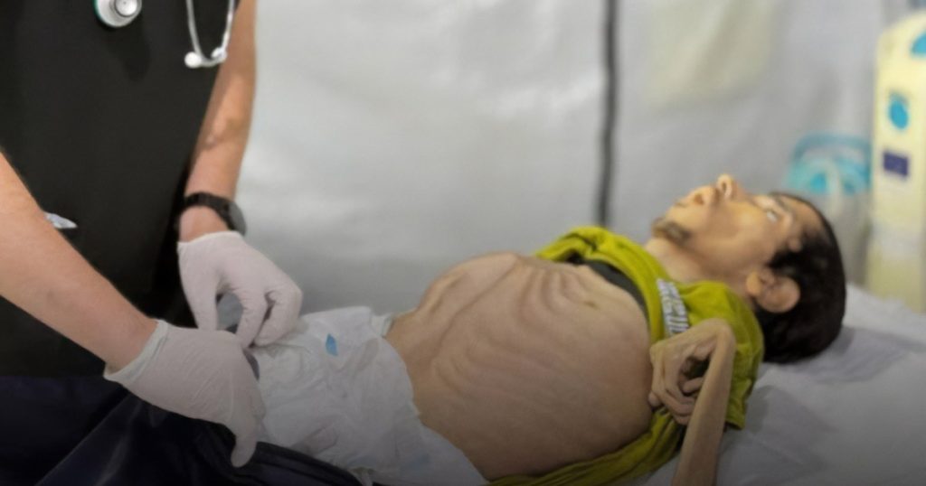 سوء التغذية بغزة يحصد أرواح الكبار والصغار بسبب الحصار الإسرائيلي