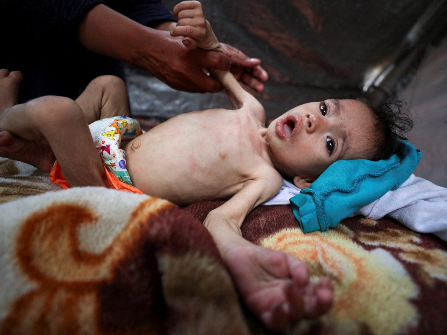 سوء التغذية يفتك بأطفال غزة