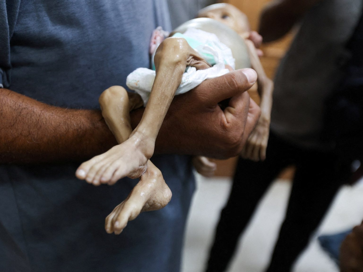 7 وفيات جديدة بسبب التجويع بغزة وسوء التغذية يهدد مئات الآلاف