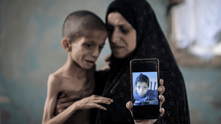 GAZA CITY, GAZA - AUGUST 05: 10-year-old Nafez Mohammed Khidr Nasser struggles with serious health issues due to malnutrition and brain atrophy in Gaza City, Gaza on August 05, 2025. His weight has dropped rapidly, and he has lost the ability to walk. Nafez and his family are living under harsh conditions in the Tuffah neighborhood, lacking basic food and medicine. With his health in critical condition, Nafez is seeking treatment abroad. Photojournalist:Ahmed Jihad Ibrahim Al-arini Publisher:Pınar Şebnem Gürel