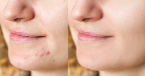 الاختراقات؟ يقول المراجعون إن هذه الرقع التي تبلغ قيمتها 6 دولارات “تقلل من البثور بين عشية وضحاها”