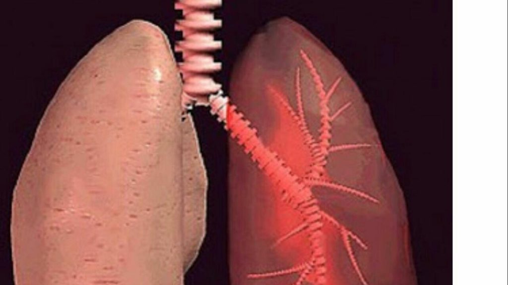 أسباب غير متوقعة وراء الإصابة بسرطان الرئة