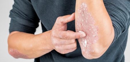 هؤلاء الأكثر عرضة للإصابة بأمراض المناعة الذاتية