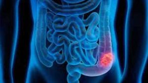 علامات مبكرة تكشف سرطان القولون والمستقيم: ماذا يجب أن تعرف؟