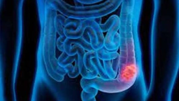 علامات مبكرة تكشف سرطان القولون والمستقيم: ماذا يجب أن تعرف؟