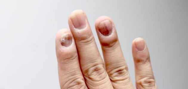 علامات على أظافرك تحذّر من مشاكل صحية لا تعرفينها