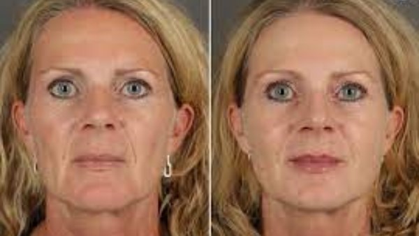 التجاعيد  والخطوط التعبيرية 