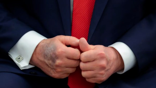 ظهور كدمات جديدة في يد ترامب تثير جدلا واسعا.. ما سبب وجودها؟