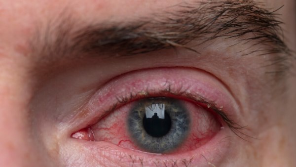 ليس مجرد حساسية… 10 أسباب مرضية قد تفسّر احمرار العين