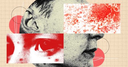 أنت في حاجة إلى أن تكون أكثر فزعًا من القوباء المنطقية