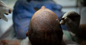 كيف اخترقت تركيا صناعة زراعة الشعر؟