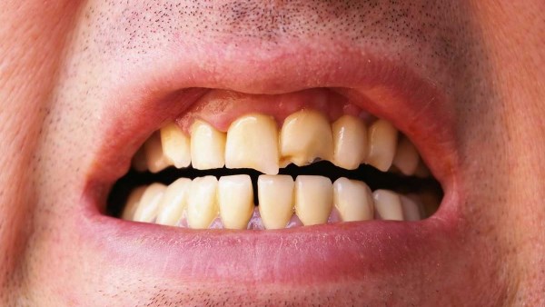 احمِ نفسك من الألم.. أهم الطرق الصحية للوقاية من مشاكل الأسنان