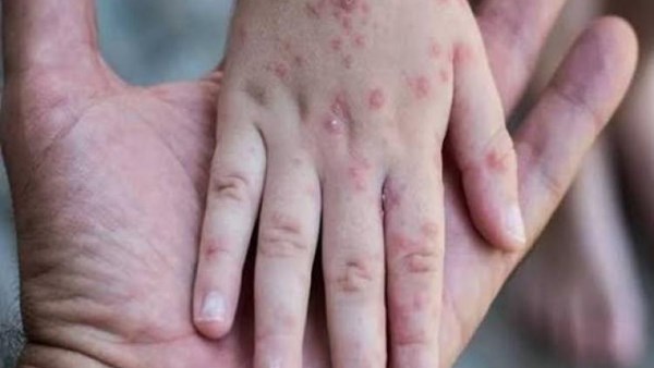 الأمم المتحدة تحذر من انتشار واسع وسريع لمرض جدري الماء في غزة