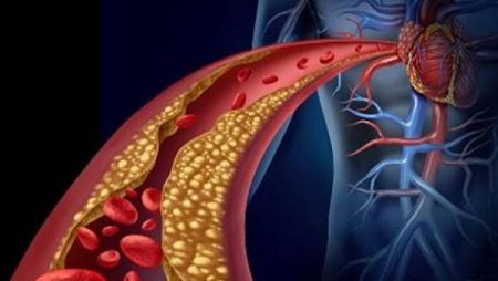 طرق طبيعية لعلاج انسداد الشرايين.. احرص على اتباعها يوميا