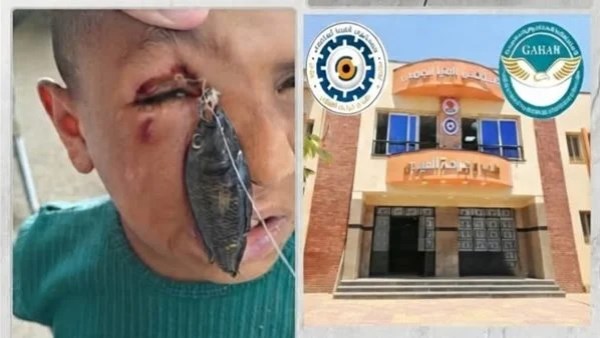 مستشفى عيون جامعة المنيا تنقذ بصر طفل من صنارة صيد