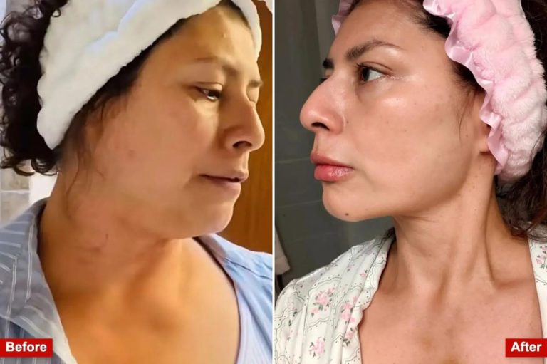 يساعد اتجاه “DIY Lipo” الخطير على التخلص من الدهون في الميزانية