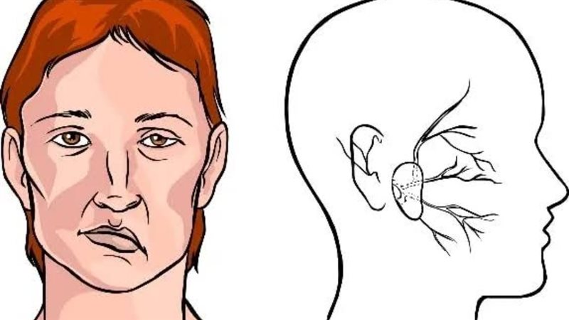 اعراض العصب السابع
