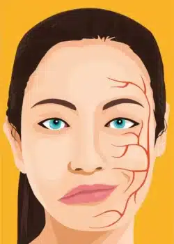 تشنج نصف الوجه (العصب السابع): أنواعه وأعراضه وأسبابه وتشخيصه