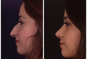 حكم تصغير الأنف.. الإفتاء توضح متى يكون جائزًا ومتى يدخل في تغيير خلق الله؟